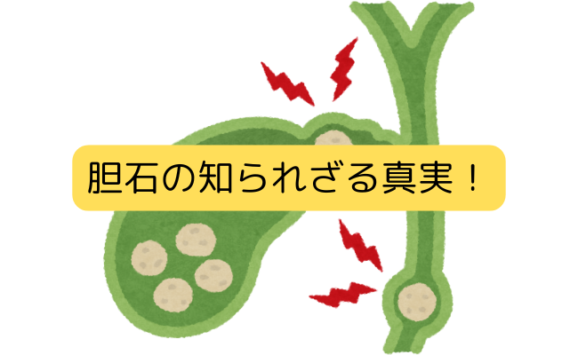 胆石の治療法と予防 - 内臓の素晴らしき世界