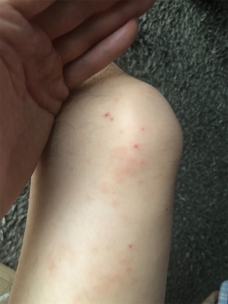閲覧注意 めちゃくちゃ毛虫に刺された 湿疹が出て地獄の痒みを味わった話 休日ぶらぶら散歩ブログ