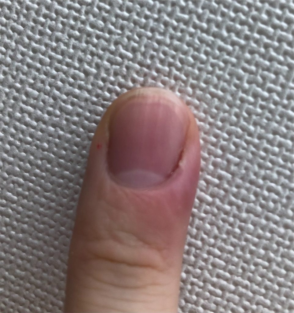 閲覧注意 ひょう疽 ひょうそ が痛い 膿が出たら楽になった話 めちゃくちゃ痛い 休日ぶらぶら散歩ブログ