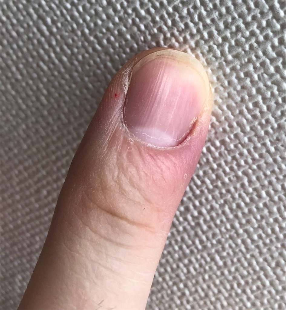 閲覧注意 ひょう疽 ひょうそ が痛い 膿が出たら楽になった話 めちゃくちゃ痛い 休日ぶらぶら散歩ブログ