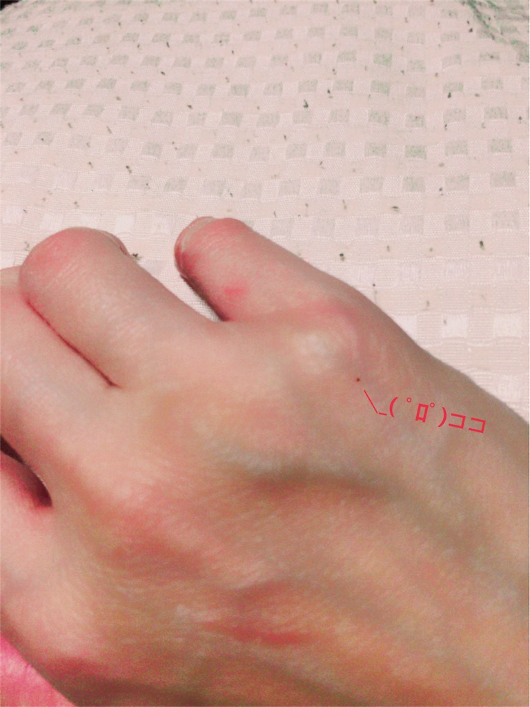 手の甲のホクロ 氣づいたら 世界は平和だった