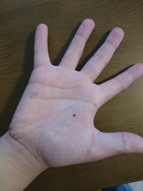 手のひらのホクロ すっとぼけの奮闘記 手のひらのホクロ すっとぼけの奮闘記