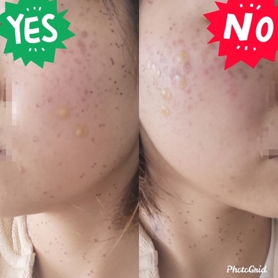 念願のシミ取り放題に行ってきた経過レポ １日目 チョコロベリーblog