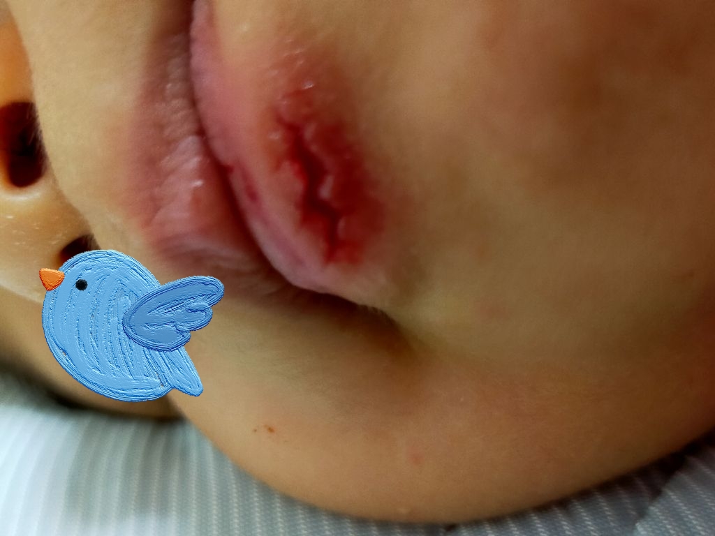 ２歳次男が夜間に顎をざっくり切る怪我をした時の話 こころもちろん たるをしる