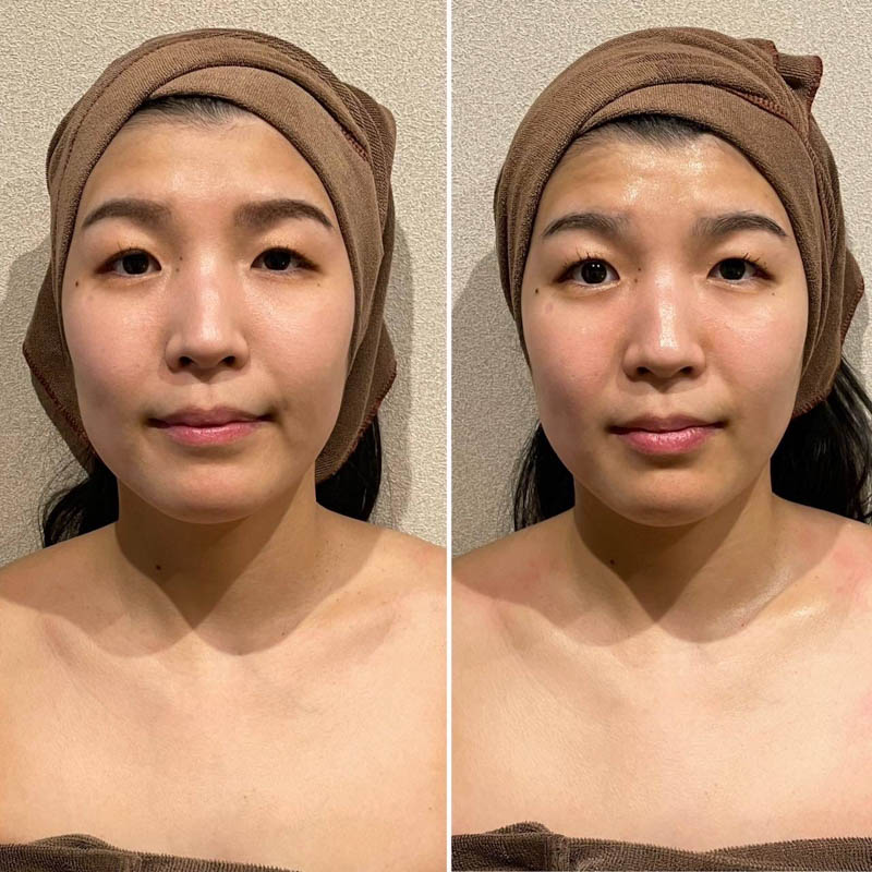 蓄熱式ハイ○の代わりエステ小顔