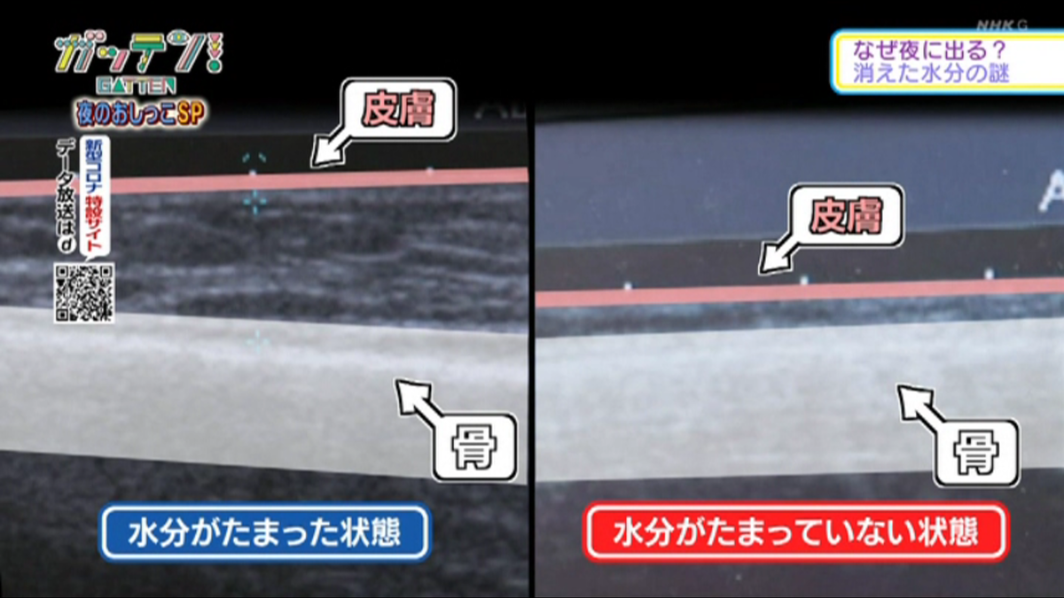 f:id:compressionstocking:20201019064440p:plain