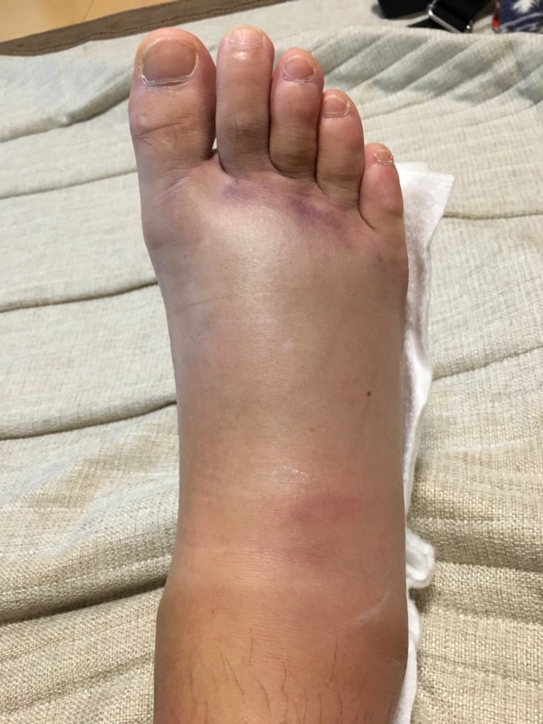 腓骨骨折 3日目 Cwynp581 S Blog
