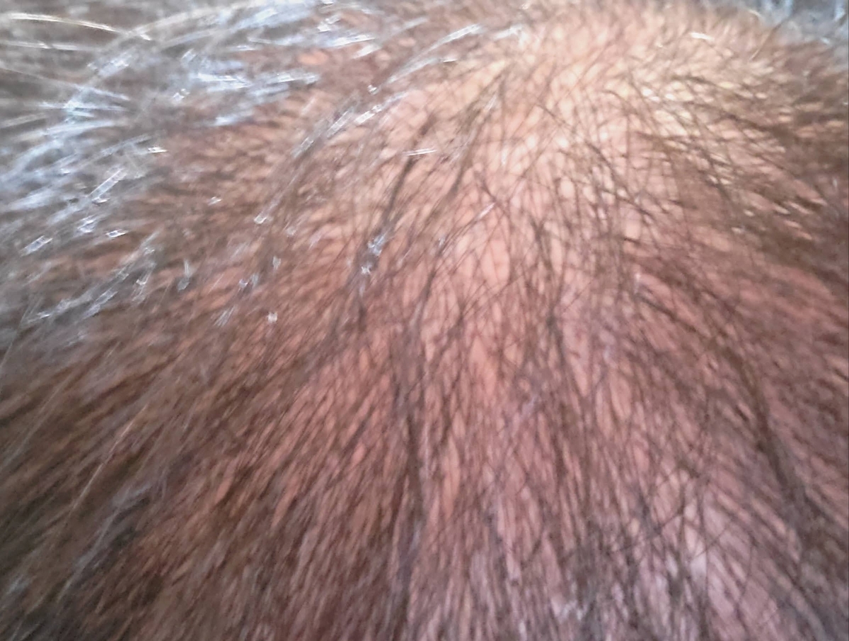 40代でスキンヘッド