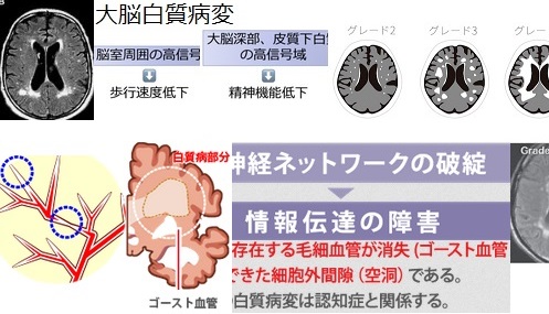 白質病変