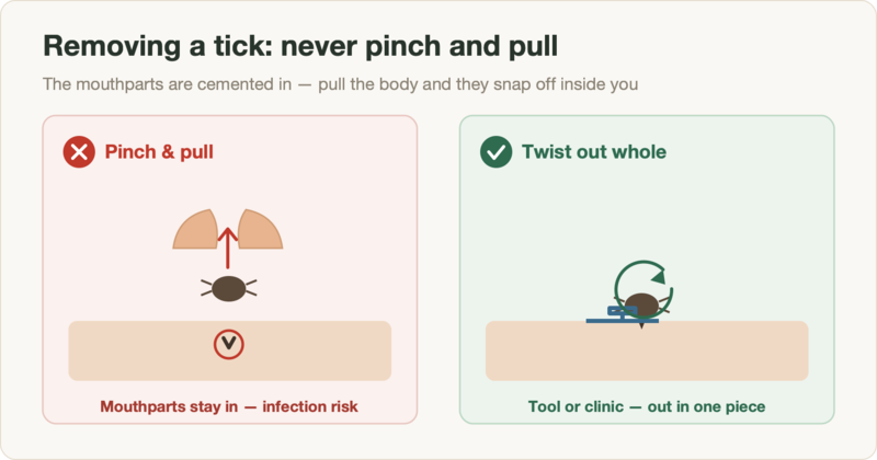 Diagram: pinching and pulling a tick leaves the mouthparts in the skin; using a tool or clinic twists it out whole