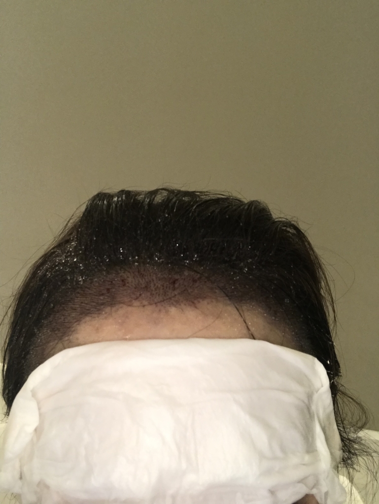 ヘアライン矯正 Decopichan S Blog