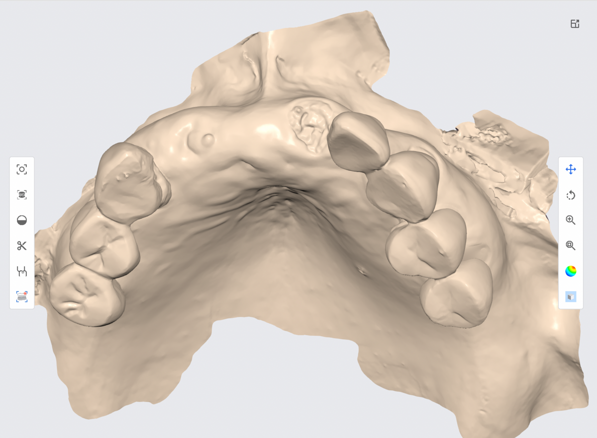 Medit Splints 1.1 アップデート スプリント以外にも使えます