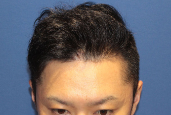 親和クリニックの施術後12ヶ月