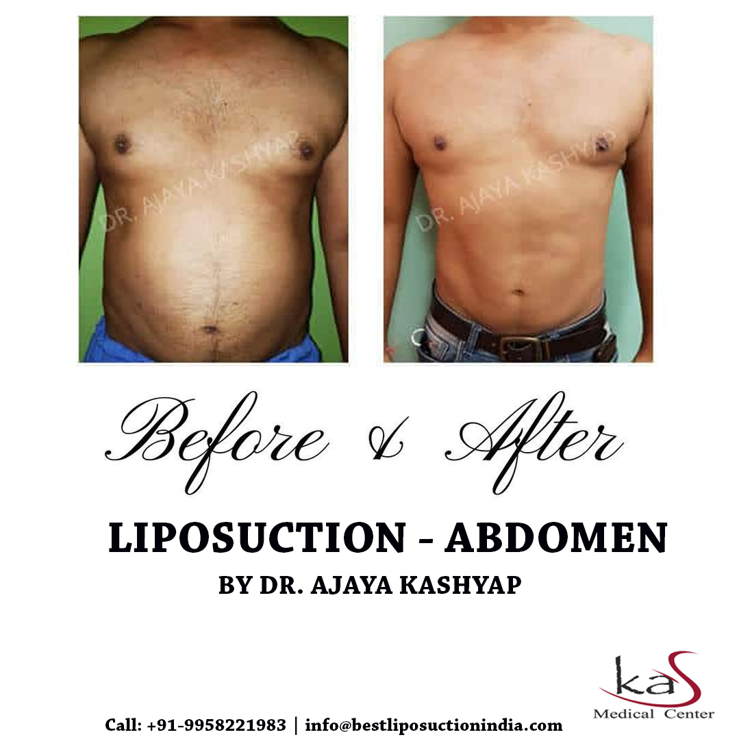 f:id:drkashyapbestsurgeonindia:20200611192044j:plain