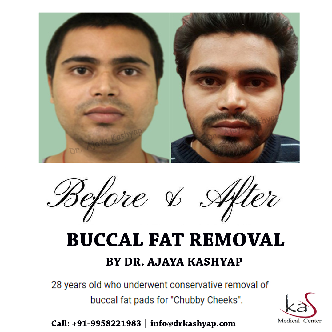f:id:drkashyapbestsurgeonindia:20200612173353j:plain