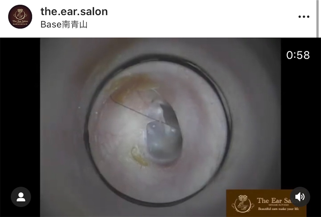 f:id:earwax-cleaning-mimisoji:20201031223149j:image f:id:earwax-cleaning-mimisoji:20201031223149j:image