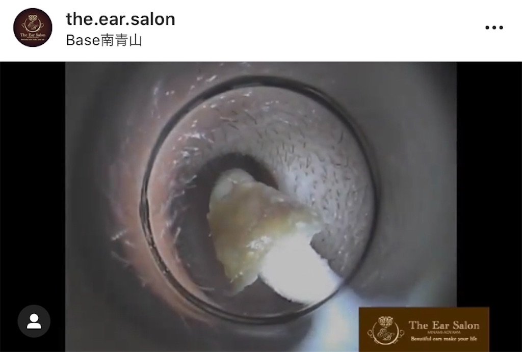f:id:earwax-cleaning-mimisoji:20201105103343j:image f:id:earwax-cleaning-mimisoji:20201105103343j:image