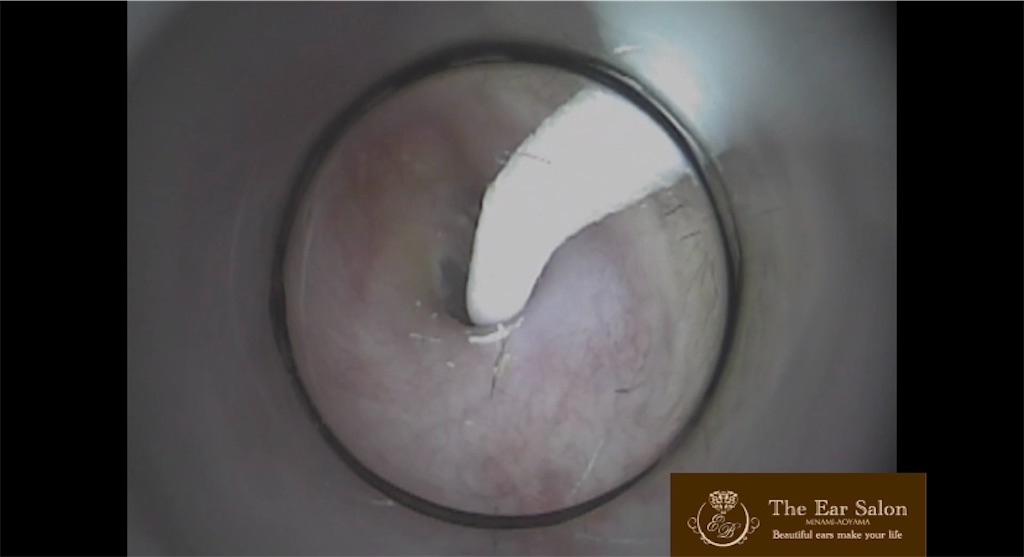 f:id:earwax-cleaning-mimisoji:20210202171651j:image f:id:earwax-cleaning-mimisoji:20210202171651j:image