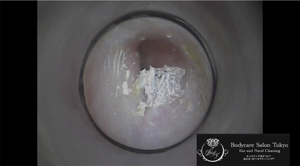 f:id:earwax-cleaning-mimisoji:20210208234956j:image