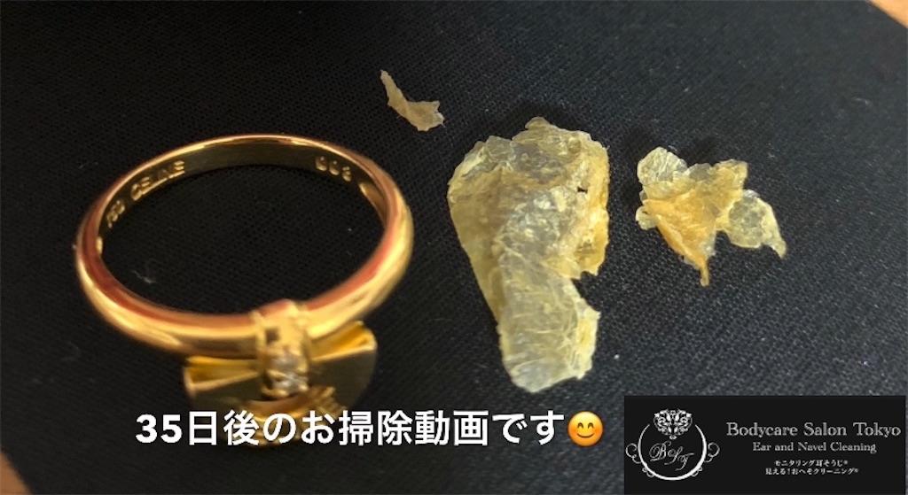 f:id:earwax-cleaning-mimisoji:20210310192156j:image f:id:earwax-cleaning-mimisoji:20210310192156j:image