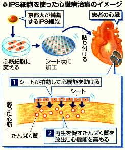 iPS細胞を使った心臓病治療のイメージ