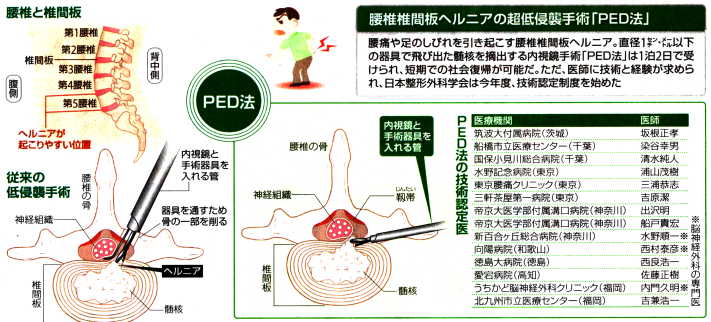 腰椎椎間板ヘルニアのＰＥＤ手術法