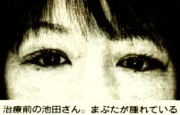 治療前の池田さん