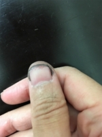 No.1047　うう、今度は指まで・・・。