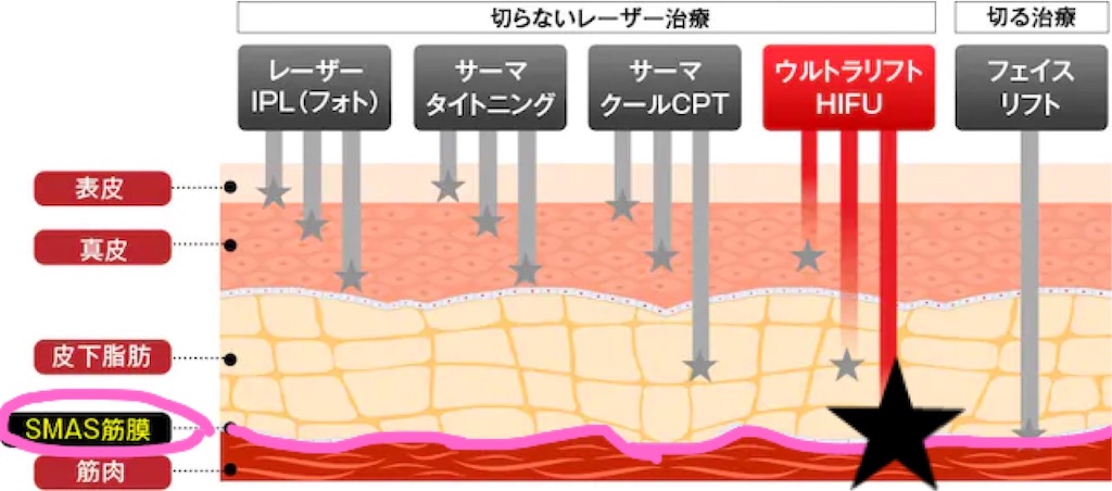 湘南 ハイフ