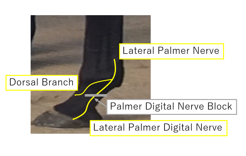 Palmer digital nerve block