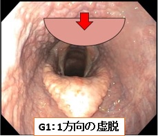 咽頭虚脱G1