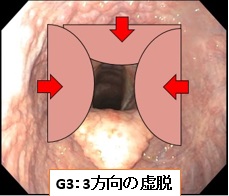 咽頭虚脱G3