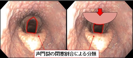 気道閉塞の重症度