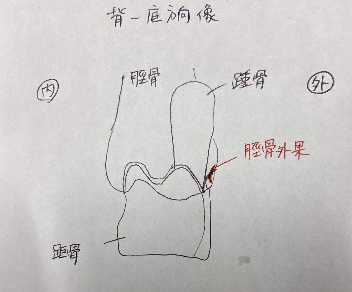 lateral fracture