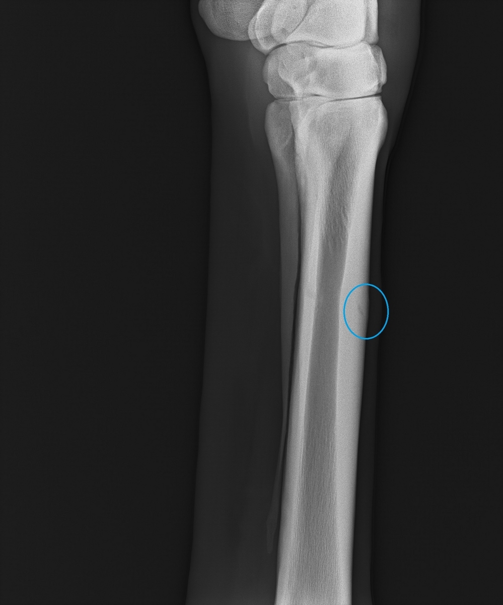 dorsal stress fracture