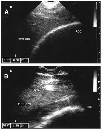 Ultrasonographic findings in horses with right dorsal colitis: five cases (2000–2001)