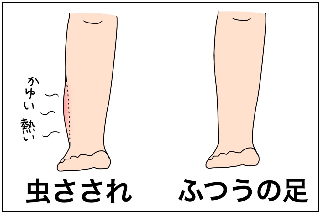 蚊に刺されると腫れて大変な人には効果抜群 ポイズンリムーバーの使い方のコツ コドモモ