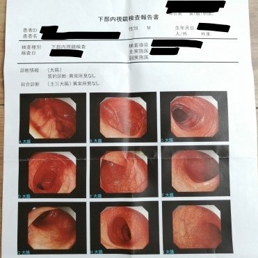 大腸内視鏡検査の結果画像