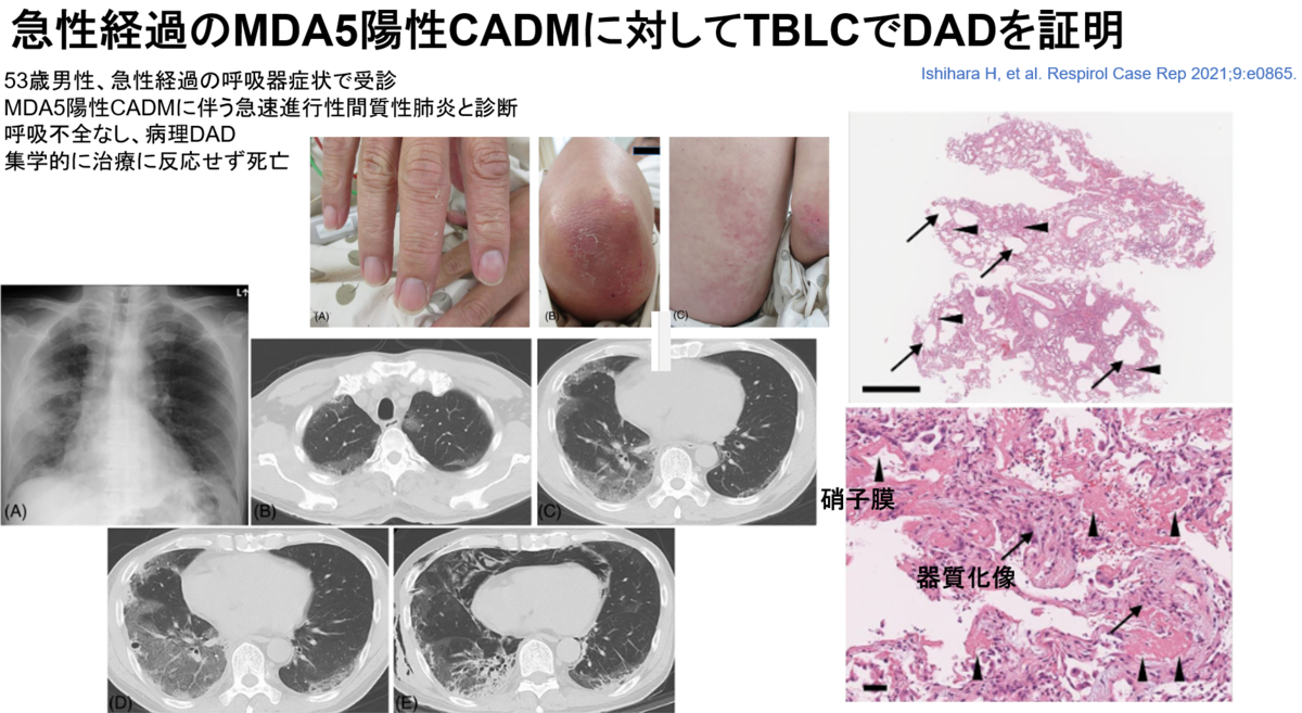 Mda5 Hand Rash mda5 皮膚筋炎 ブログ – 抗 mda5 抗体陽性皮膚 筋炎 ブログ – PBYR