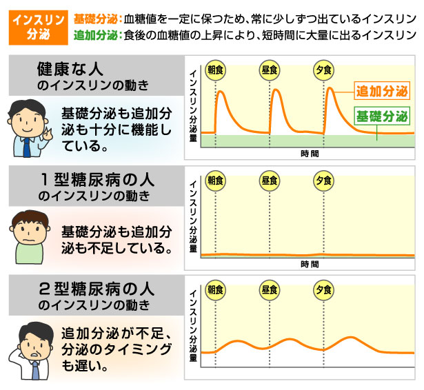 基礎インスリンと追加インスリンの分泌分泌のグラフを正常・1型糖尿病・2型糖尿病で比較し説明している