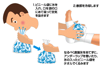 氷をビニール袋に入れて冷やす方法の説明図