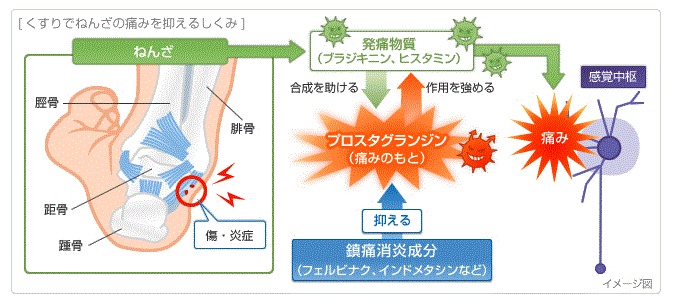 捻挫の痛みの原因と湿布薬の効果の図