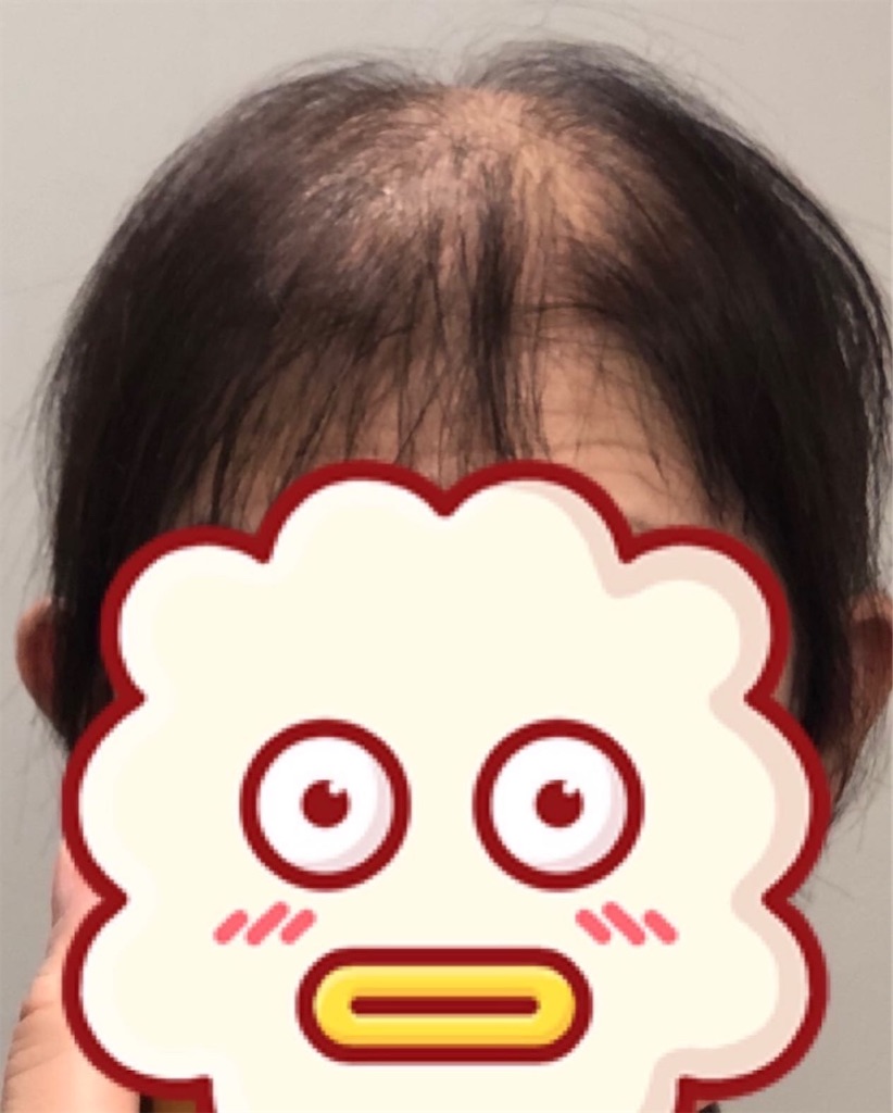 f:id:folliculogenesis:20211223182021j:image f:id:folliculogenesis:20211223182021j:image