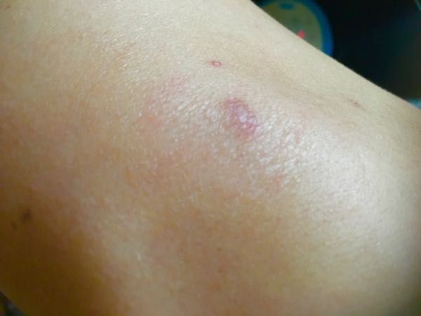 ニキビ イボ 赤ほくろ 肩に一年以上治らないできものが 100点均一 生活を100点に