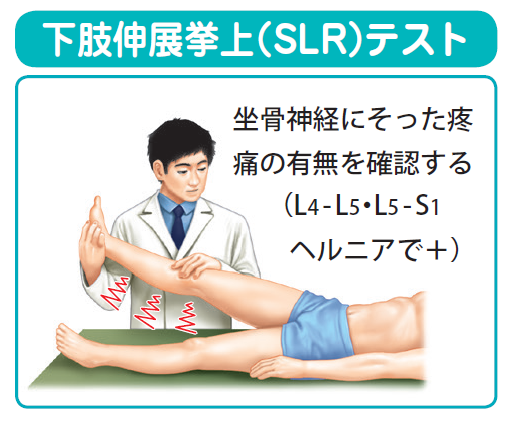 腰椎椎間板ヘルニア チェック 下肢伸展挙上試験(SLRT)