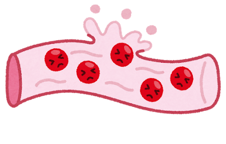 絨毛膜下血腫