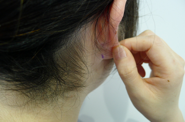 脂肪吸引の傷跡 傷あとをキレイに治すための注意点 美容外科クリニックではたらく医師のブログ