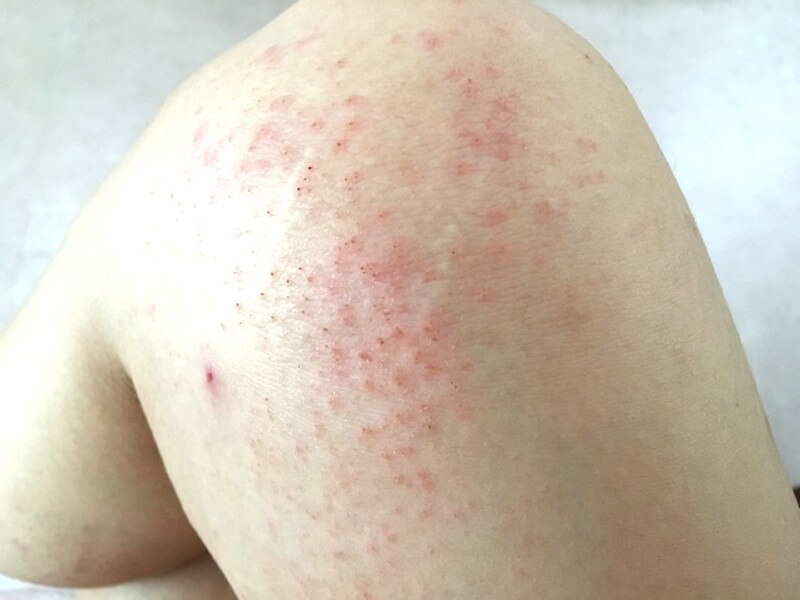 アトピー性皮膚炎