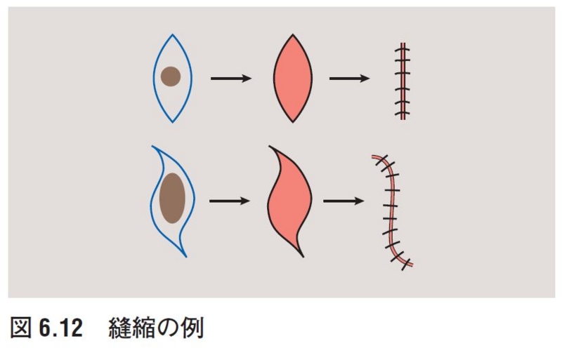 分層植皮厚さ _ 有茎皮弁とは _ 植皮 – GZBWK