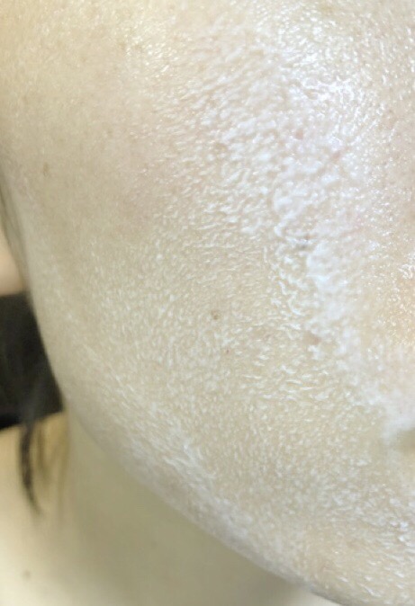 ニキビを治す正しいクレンジングの方法乳化